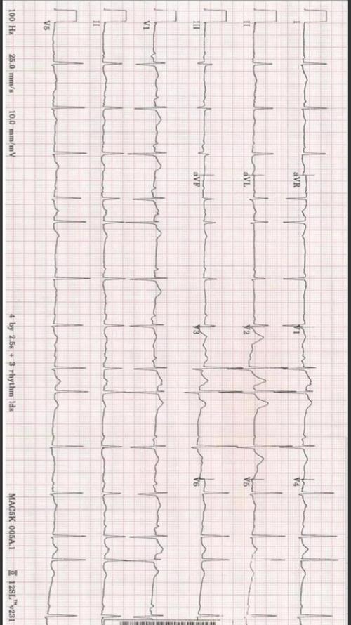 60种常见心电图一览(第一篇-器质性改变) 60种常见心电图一览(第一篇-器质性改变)