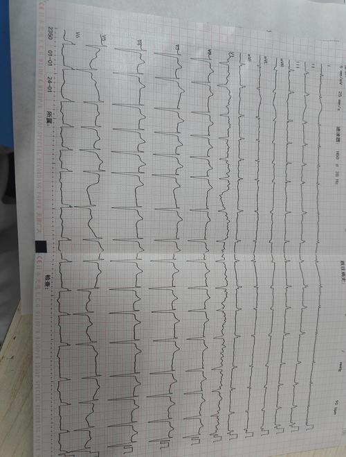 60种常见心电图一览(第一篇-器质性改变) 60种常见心电图一览(第一篇-器质性改变)